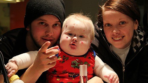 Hugo: il bambino che può morire semplicemente urtando qualcosa