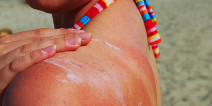 SOS Eritema Solare: 8 Utili Consigli Per Dare Sollievo Immediato SOS Eritema Solare: 8 Utili Consigli Per Dare Sollievo Immediato