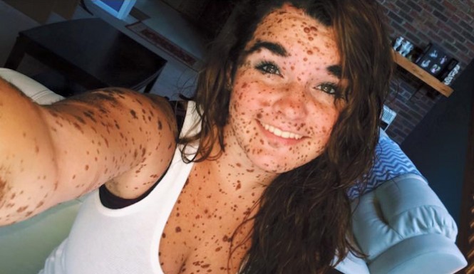 “Sono baciata dagli angeli”. Così l’adolescente Ciera Swaringen spiega i propri nei e sfida il bullismo