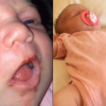 Neonata Rischia la Vita per un Herpes. La mamma: “Non fateli Baciare!"