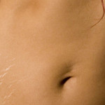 Smagliature: Ecco Come Prevenirle e Provare ad Eliminarle!