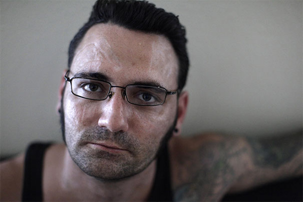 "Come e perché ho rimosso i tatuaggi razzisti dal mio volto"