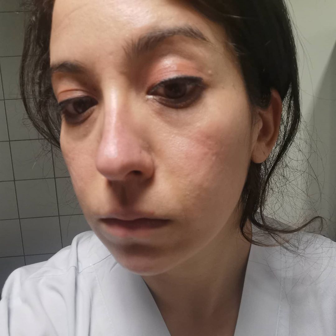 I segni sul volto delle donne che stanno combattendo il Coronavirus in prima linea