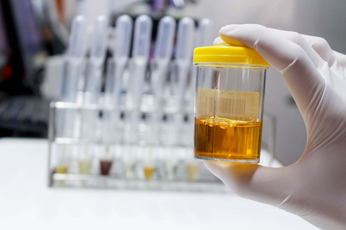 Se vedi sangue nelle urine, non è una semplice infezione