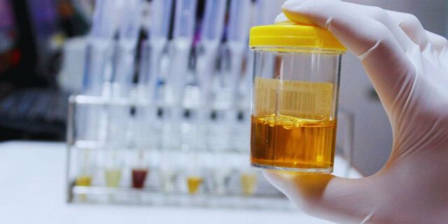 Urine scure al risveglio? Non ignorarle e vai subito dal medico: ecco il motivo