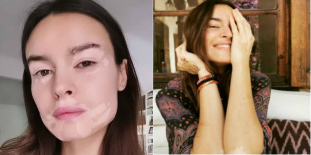 Perché il filtro instagram vitiligine di Kasia Smutniak è diverso da tutti gli altri