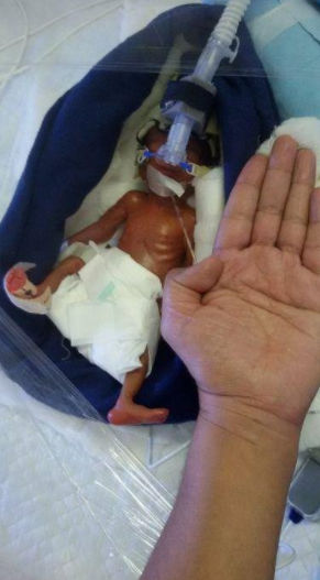 Manushi, la bambina prematura più piccola del mondo torna a casa