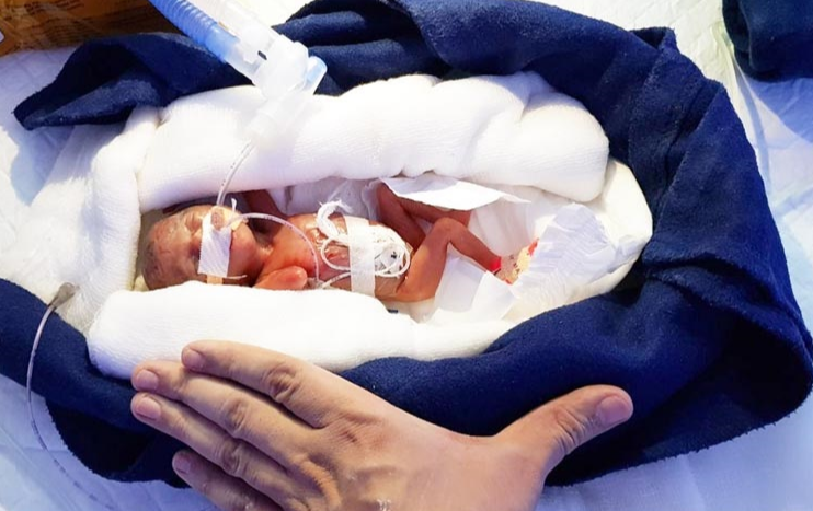 Manushi, la bambina prematura più piccola del mondo torna a casa