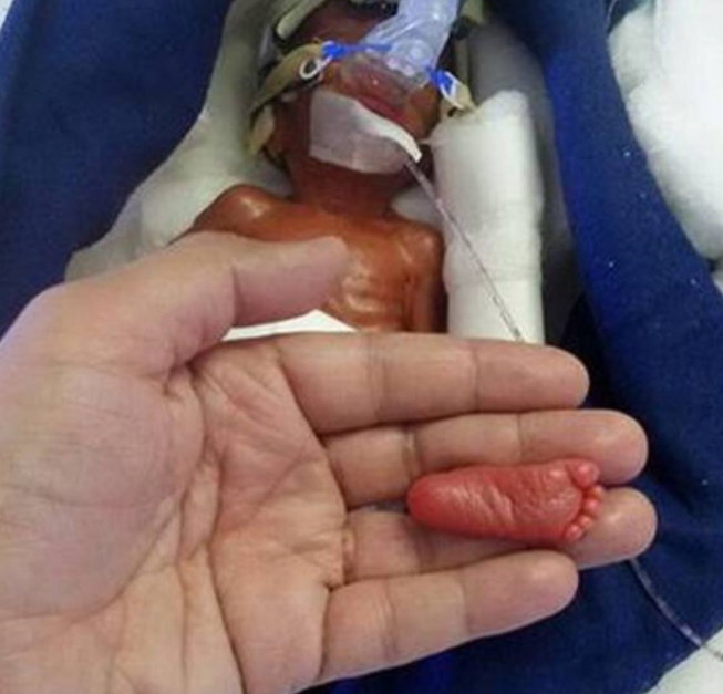 Manushi, la bambina prematura più piccola del mondo torna a casa