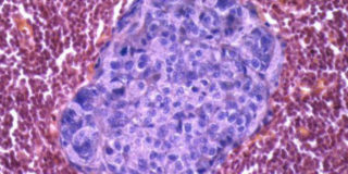 cancro al colon retto