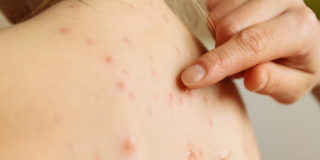 morbillo