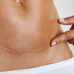 Post Parto Cesareo: 10 Cose da Fare per Recuperare la Forma
