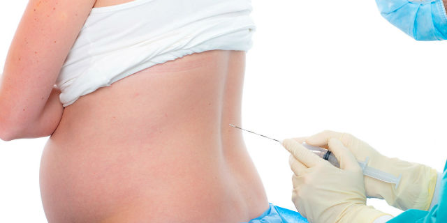 parto indotto con epidurale