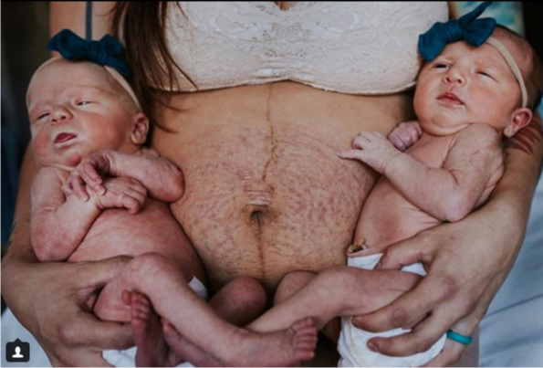 "Perché dovremmo condividere tutte le foto del nostro corpo dopo il parto"
