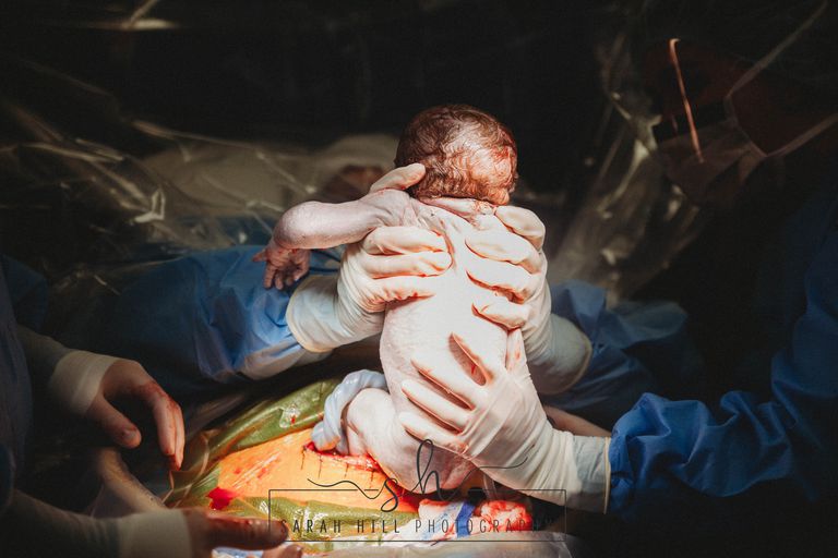 Gli scatti del parto cesareo di Emily, che ha estratto il bambino dalla sua pancia