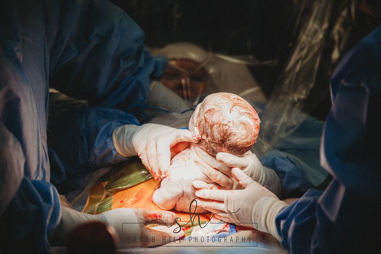Gli scatti del parto cesareo di Emily, che ha estratto il bambino dalla sua pancia
