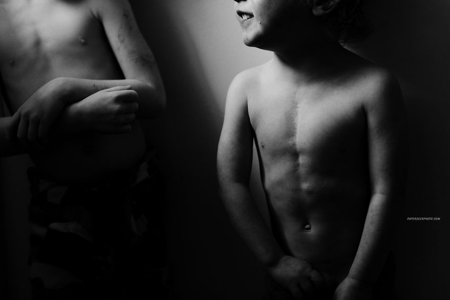 "La storia di nostro figlio di 4 anni e delle sue 3 operazioni a cuore aperto"