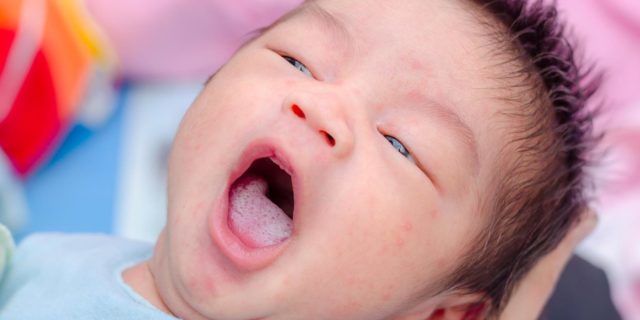 mughetto neonato sintomi