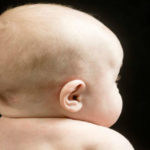 Craniostenosi: cause e tipologie delle malformazioni della testa del neonato