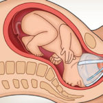 Parto con ventosa: 5 testimonianze per sapere la verità