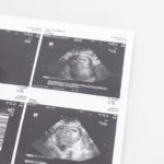 Se non reimpiantare i feti di gravidanze extrauterine è "omicidio abortivo"