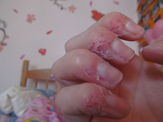 Dermatillomania