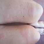 "Ho la psoriasi e ho passato la mia vita a nascondermi: ora non lo faccio più"