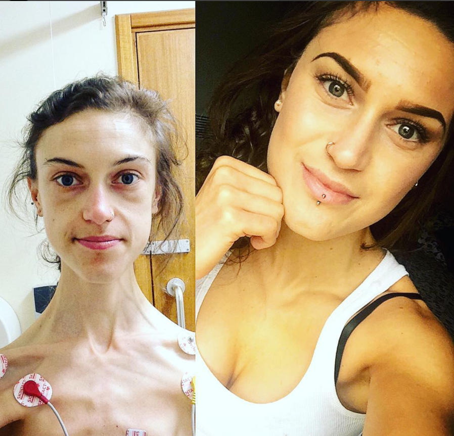 "Io, durante e dopo l'anoressia": la testimonianza in immagini di Emelle