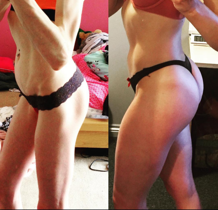 "Io, durante e dopo l'anoressia": la testimonianza in immagini di Emelle