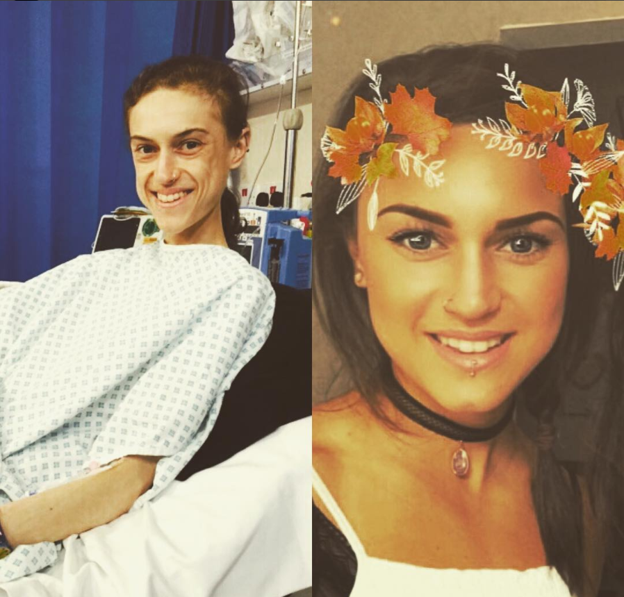 "Io, durante e dopo l'anoressia": la testimonianza in immagini di Emelle