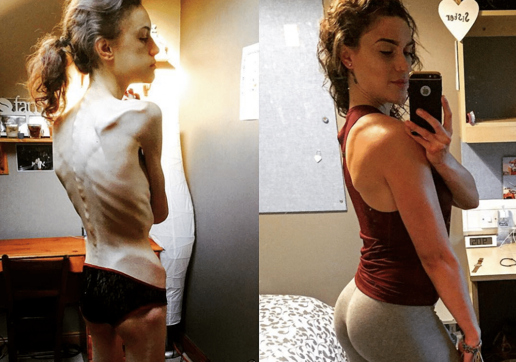 "Io, durante e dopo l'anoressia": la testimonianza in immagini di Emelle