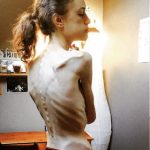 "Io, durante e dopo l'anoressia": la testimonianza in immagini di Emelle