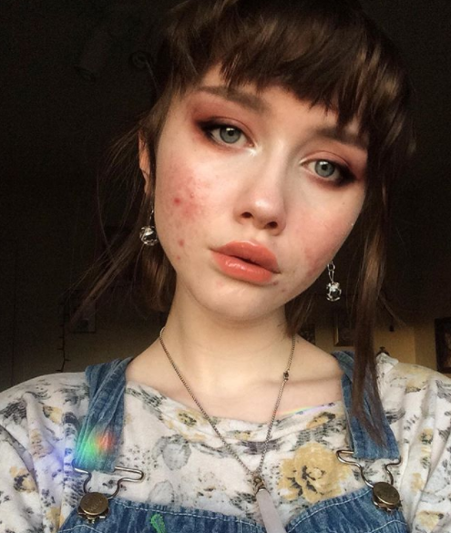 "Ero stanca di nascondermi: l'acne non ti rende brutta, un cuore pieno di odio sì"