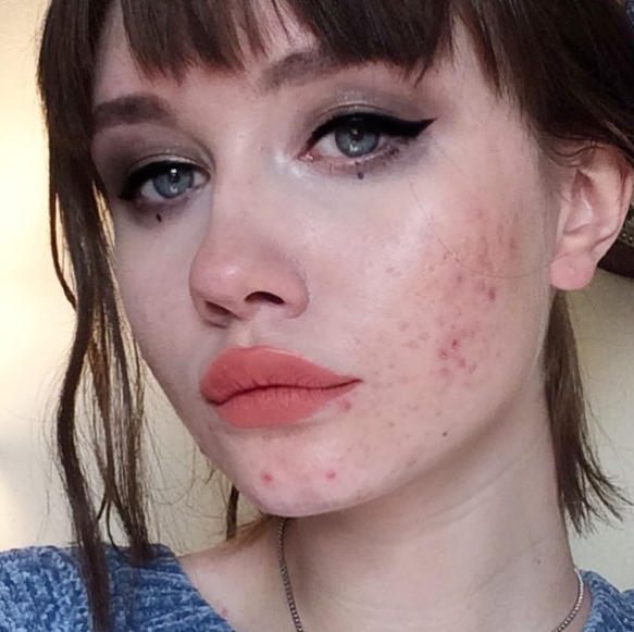 "Ero stanca di nascondermi: l'acne non ti rende brutta, un cuore pieno di odio sì"