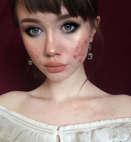 "Ero stanca di nascondermi: l'acne non ti rende brutta, un cuore pieno di odio sì"