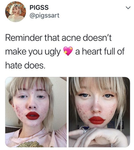 "Ero stanca di nascondermi: l'acne non ti rende brutta, un cuore pieno di odio sì"