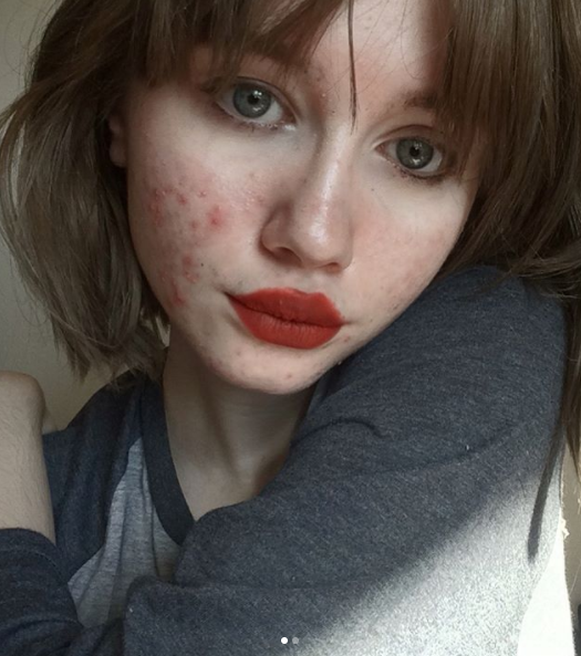 "Ero stanca di nascondermi: l'acne non ti rende brutta, un cuore pieno di odio sì"