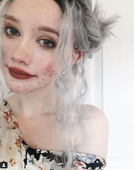 "Ero stanca di nascondermi: l'acne non ti rende brutta, un cuore pieno di odio sì"