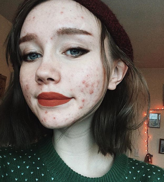 "Ero stanca di nascondermi: l'acne non ti rende brutta, un cuore pieno di odio sì"