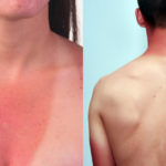 Come prevenire l’eritema solare - IlGiornale.it