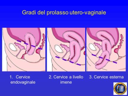 cistocele gradi