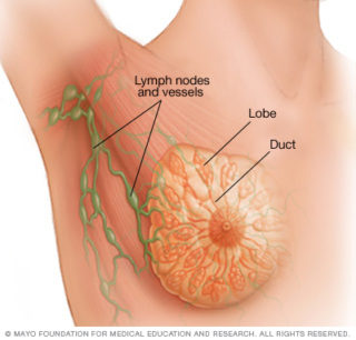 fibroadenoma al seno