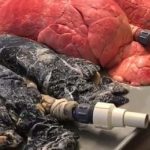 "Un polmone di un fumatore e un polmone sano": lo scioccante post dell'infermiera