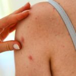 Eczema: sintomi, cause e cura