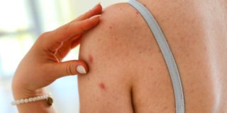Eczema