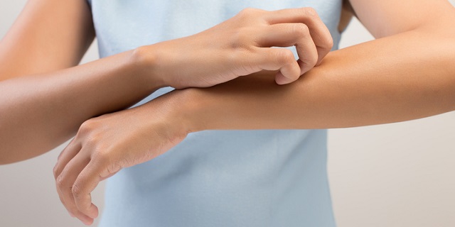 Eczema sintomi