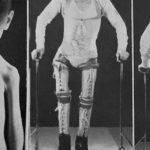 "Oggi la polio non è più la polio": un medico spiega perché il vaccino è indispensabile