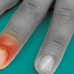 Perionissi, quando la manicure diventa pericolosa