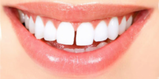 diastema