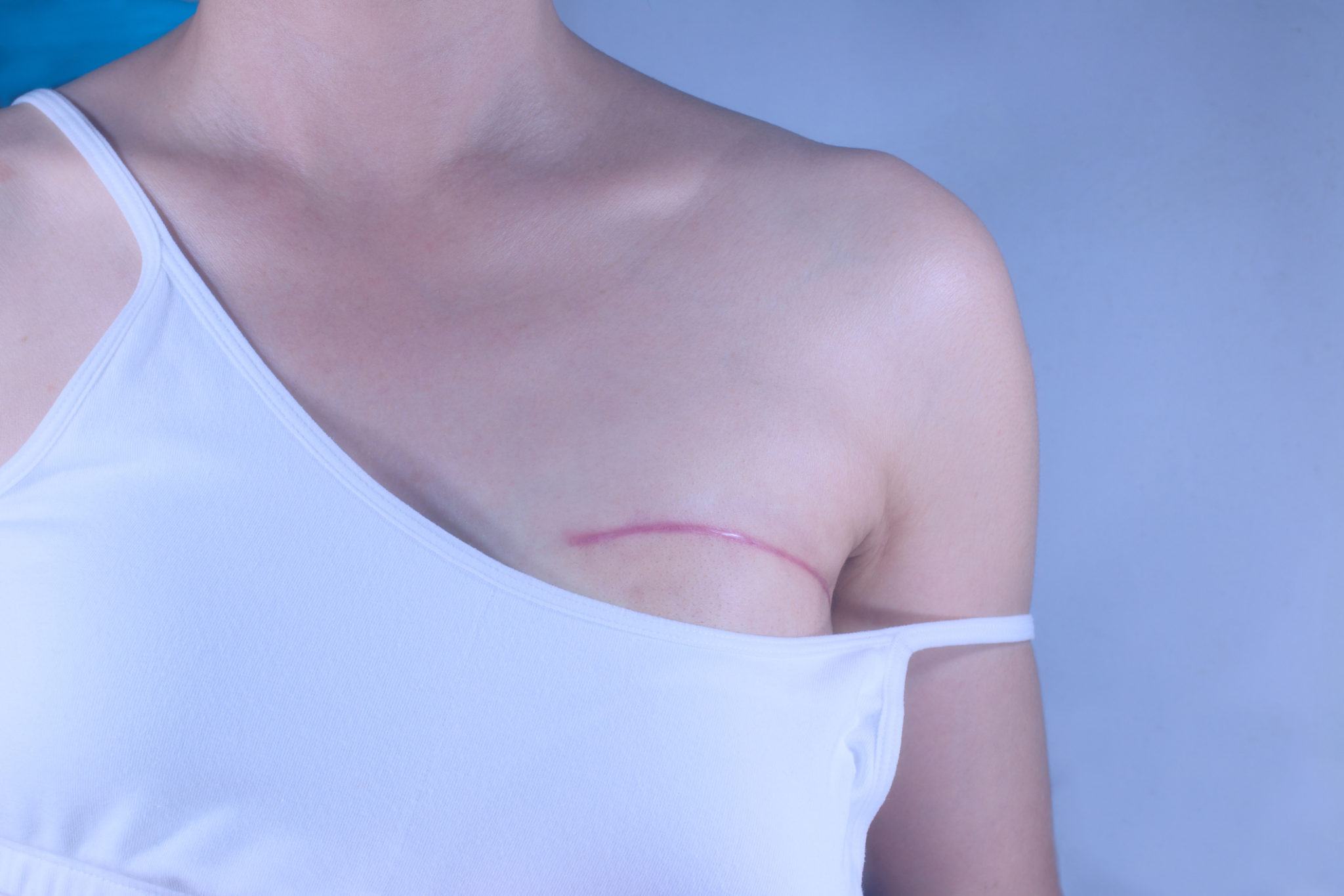 Il diritto delle donne a non volere un seno nuovo dopo la mastectomia